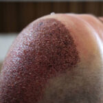 Why Sideburn Hair Transplant in Dubai Takes Time to Grow