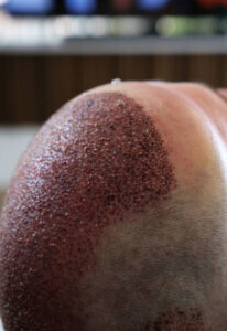Why Sideburn Hair Transplant in Dubai Takes Time to Grow 1 Why Sideburn Hair Transplant in Dubai Takes Time to Grow