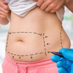 Tummy Tuck Surgery and Its Role in Enhancing Body Contour