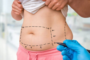 Tummy Tuck Surgery and Its Role in Enhancing Body Contour