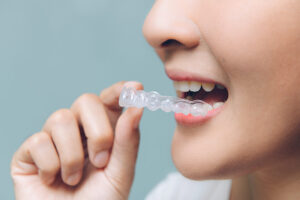 Can Mouth Guards Help Prevent Tooth Wear and Cracks?