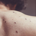 Mole Removal: What Patients Should Know About Skin Testing and Biopsy