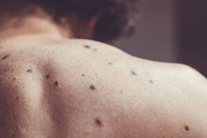 Mole Removal: What Patients Should Know About Skin Testing and Biopsy