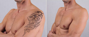 How Laser Tattoo Removal Targets Unwanted Tattoo Ink 1 How Laser Tattoo Removal Targets Unwanted Tattoo Ink