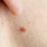 Wart Removal and Skin Examination: When Diagnosis Matters Most 3 Wart Removal and Skin Examination: When Diagnosis Matters Most