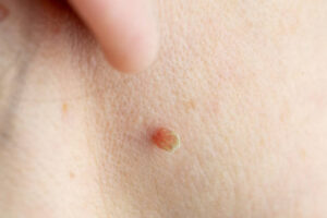 Wart Removal and Skin Examination: When Diagnosis Matters Most 1 Wart Removal and Skin Examination: When Diagnosis Matters Most