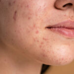 Acne Scar Treatment in Jayanagar: Complete Guide to Treatments, Cost & Recovery