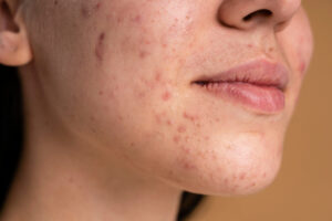 Acne Scar Treatment in Jayanagar: Complete Guide to Treatments, Cost & Recovery 1 Acne Scar Treatment in Jayanagar: Complete Guide to Treatments, Cost & Recovery