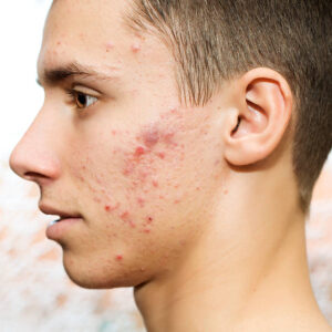Pimples Treatment Solutions for Improving the Appearance of Acne-Prone Skin 1 Pimples Treatment Solutions for Improving the Appearance of Acne-Prone Skin