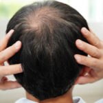 Understanding Hair Follicles Before Starting Hair Loss Treatment