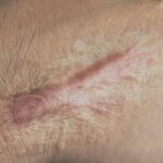 Is Scar Camouflage Tattooing a Good Alternative to Surgical Scar Revision in Islamabad?