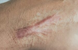 Is Scar Camouflage Tattooing a Good Alternative to Surgical Scar Revision in Islamabad? 1 Is Scar Camouflage Tattooing a Good Alternative to Surgical Scar Revision in Islamabad?