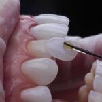 Achieving a Brighter Smile with Dental Veneers