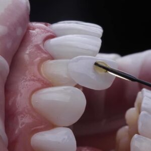 Achieving a Brighter Smile with Dental Veneers 1 Achieving a Brighter Smile with Dental Veneers