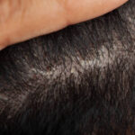 Is Stem Cell Hair Transplant in Dubai a Non-Surgical Treatment? 4 Is Stem Cell Hair Transplant in Dubai a Non-Surgical Treatment?