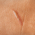 Laser scar removal in Riyadh 2