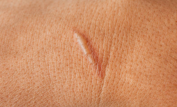Laser scar removal in Riyadh 2