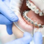 When Should You Consider Braces?