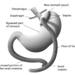 How to Find the Best Bariatric Surgeon in Islamabad
