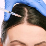 PRPHairTreatment for Hair Transplant Patients: How It May Support Recovery