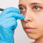 Rhinoplasty in Riyadh 13 1