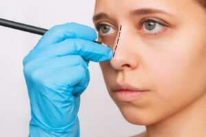 Rhinoplasty Considerations for Maintaining Natural Facial Expression