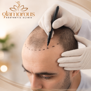 Modern Hair Transplant Techniques in Islamabad at Glamorous Aesthetic Clinic