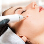 Choosing the Right Treatment for Common Warts