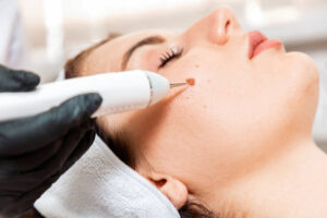 Choosing the Right Treatment for Common Warts