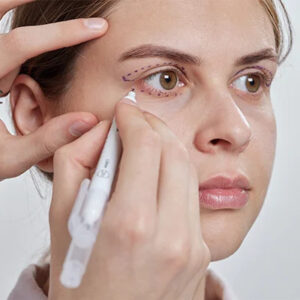 Upper Blepharoplasty In Dubai: Refresh Your Upper Eye Contours