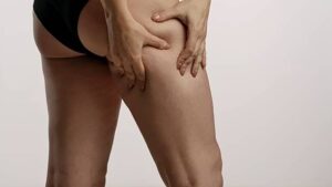 How Can You Manage Pain During Lipedema Recovery? 1 How Can You Manage Pain During Lipedema Recovery?