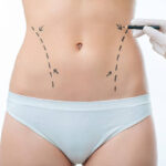 Liposuction Treatment Expectations for a More Defined Physique