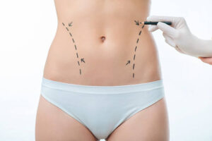 Liposuction Treatment Expectations for a More Defined Physique