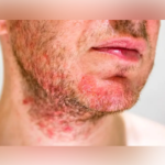 7 Important Facts About Seborrheic Keratosis Remedies