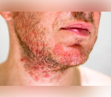 7 Important Facts About Seborrheic Keratosis Remedies