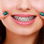 How Braces Support Growing Smiles 3 How Braces Support Growing Smiles