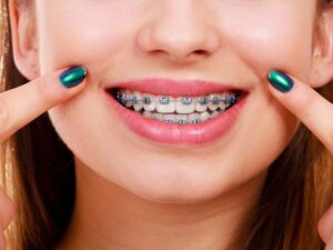 How Braces Support Growing Smiles 1 How Braces Support Growing Smiles