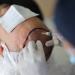 Crown Hair Transplant in Dubai: Cost, Grafts & Recovery Explained
