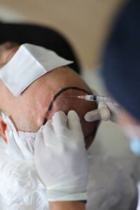 Crown Hair Transplant in Dubai: Cost, Grafts & Recovery Explained 1 Crown Hair Transplant in Dubai: Cost, Grafts & Recovery Explained