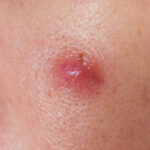 Does Insurance Cover Sebaceous Cyst Removal?