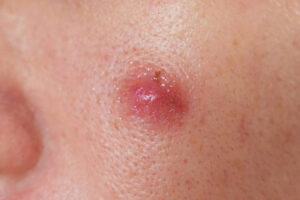 Does Insurance Cover Sebaceous Cyst Removal?