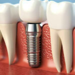 What Questions Should You Ask About Implant Materials Before Treatment?
