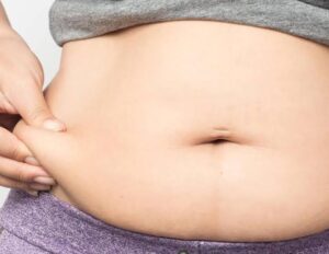 Who Is the Best Candidate for Liposuction in Islamabad?
