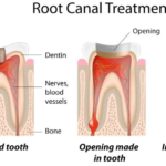 Root Canal Treatment in Manila: Expert Dental Care to Preserve Your Natural Teeth