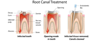 Root Canal Treatment in Manila: Expert Dental Care to Preserve Your Natural Teeth