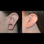 Earlobe Correction Surgery 800