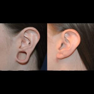 Earlobe Correction Surgery: Can It Fix Stretched Ear Openings?