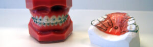 Can Dental Activators Help Guide Proper Teeth Development? 1 Can Dental Activators Help Guide Proper Teeth Development?