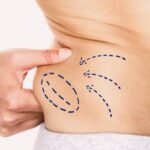 Can Fat Transfer Treatment in Islamabad Improve Facial Hollows After Weight Loss?