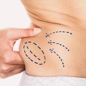 Can Fat Transfer Treatment in Islamabad Improve Facial Hollows After Weight Loss? 1 Can Fat Transfer Treatment in Islamabad Improve Facial Hollows After Weight Loss?